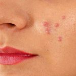 با جوش دوران بلوغ چه کنیم؟