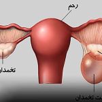 کیست تخمدان چیست؟